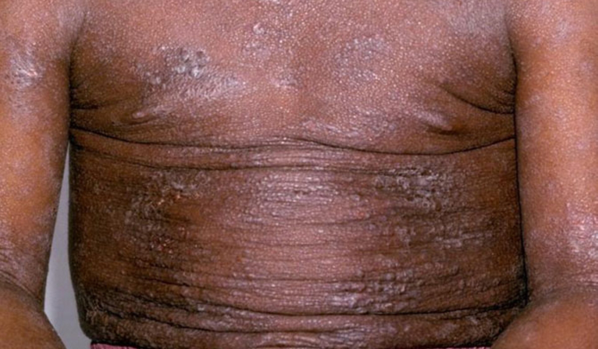 Dry skin is a big problem for those who have it as the skin feels flaky and mostly itchy.