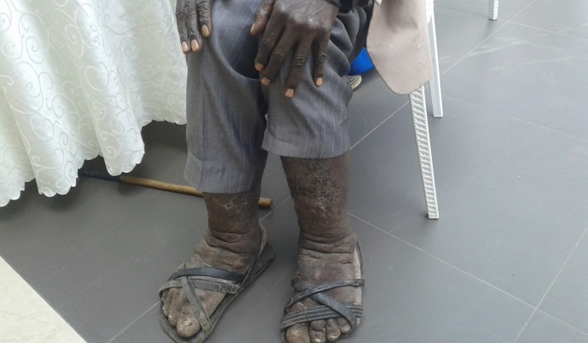 Podoconiosis is a non-infectious form of elephantiasis caused by long-term contact with irritant red clay soil of volcanic origins. Courtesy