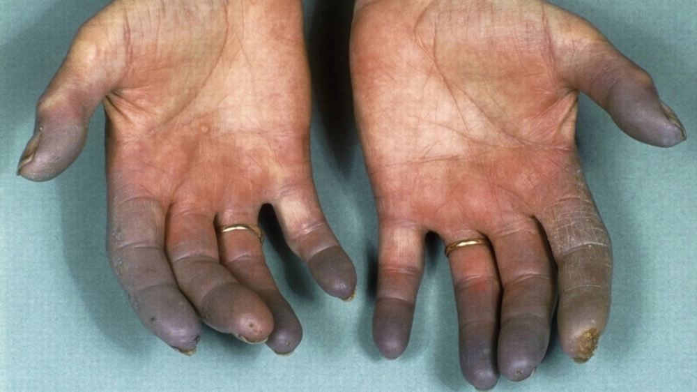 Buerger’s Disease, also known as thromboangitis obliterans, is a chronic and disabling condition that ultimately leads to the loss of one or more limbs. Internet