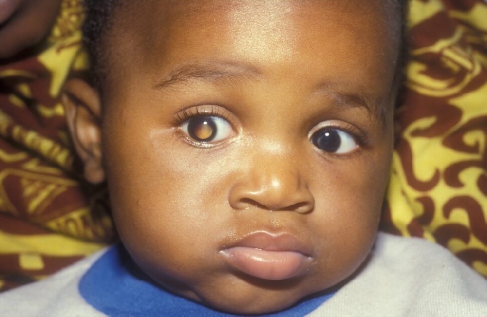 Retinoblastoma is the most common eye cancer that affects children worldwide, and early diagnosis and treatment are critical to prevent death or the loss of an eye. Net photo.