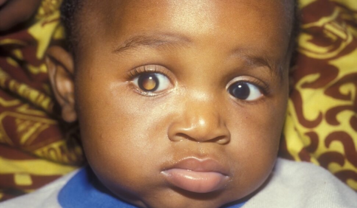 Retinoblastoma is the most common eye cancer that affects children worldwide, and early diagnosis and treatment are critical to prevent death or the loss of an eye. Net photo.
