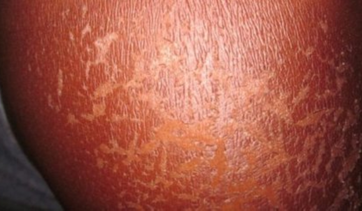 A sunburn is a form of radiation injury that occurs due to overexposure to hot sun, affecting the skin and eyes.