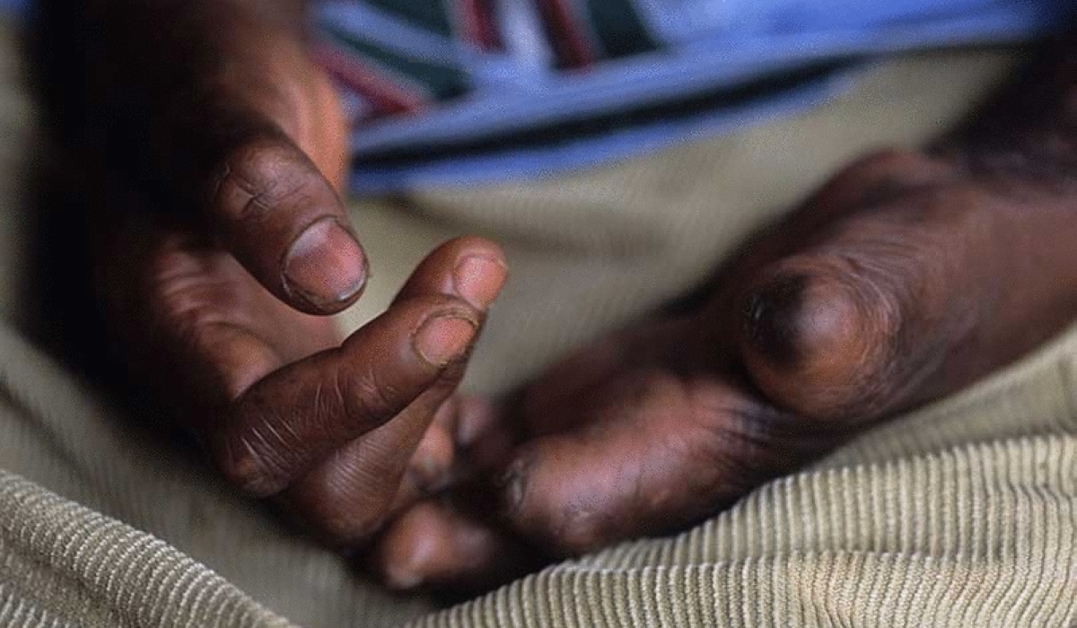 Rwanda is among countries that are in the process of eradicating leprosy. Courtesy