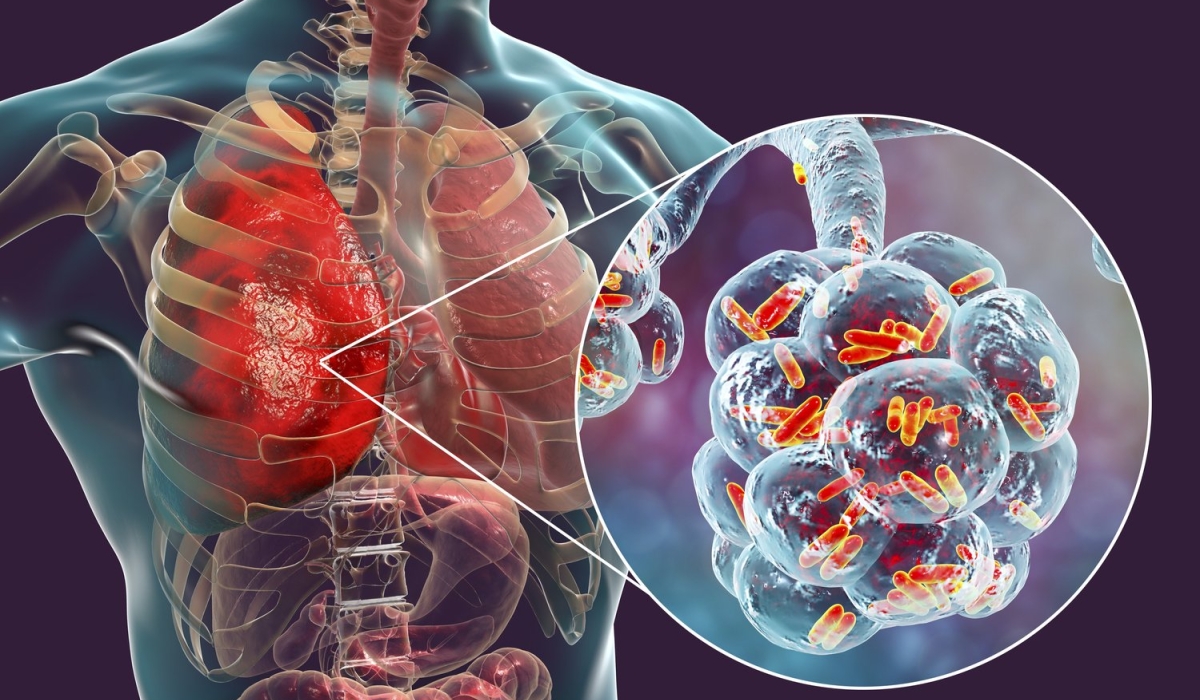 Akagera Medicines said it has completed early-stages of its preclinical trials of AKG-100, a new antibiotic drug in the oxazolidinone class, designed to treat pulmonary TB. 