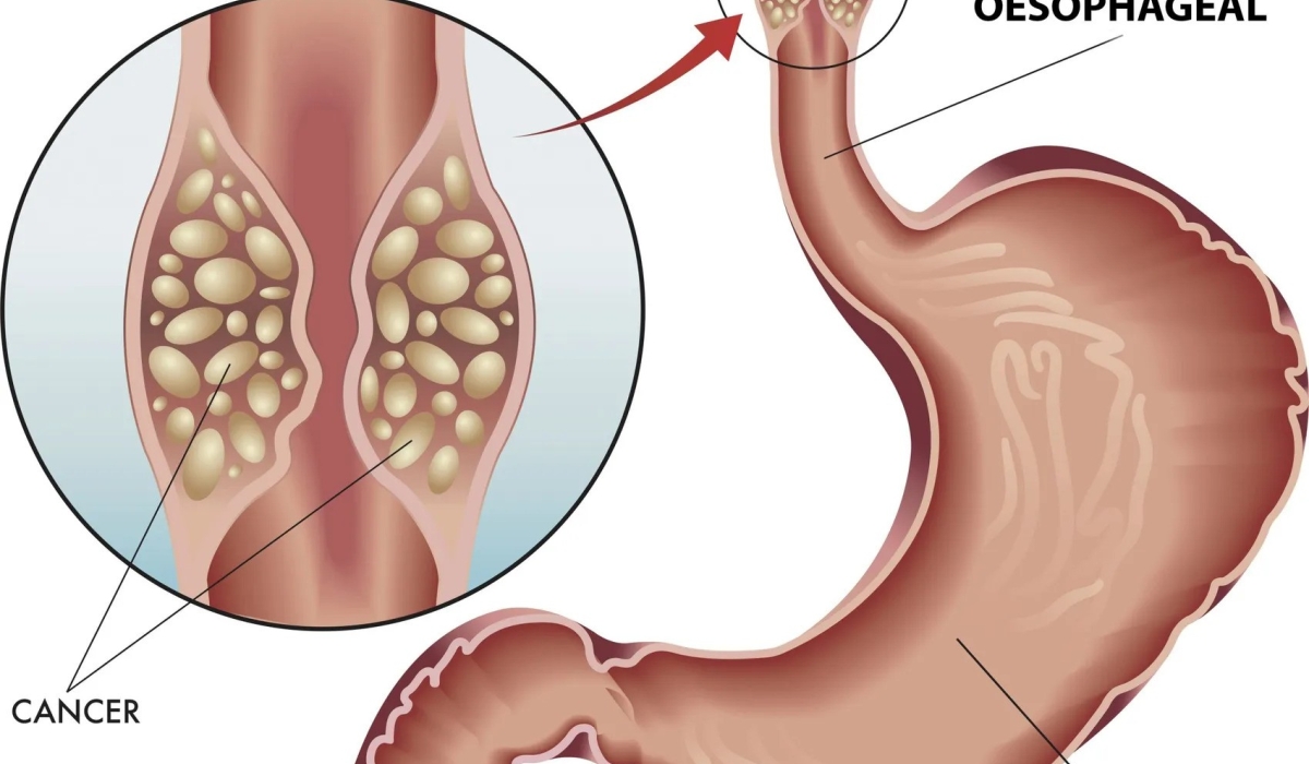 Esophageal cancer is emerging as an increasingly serious health concern in Rwanda, with new cases persistently rising over the past five years.