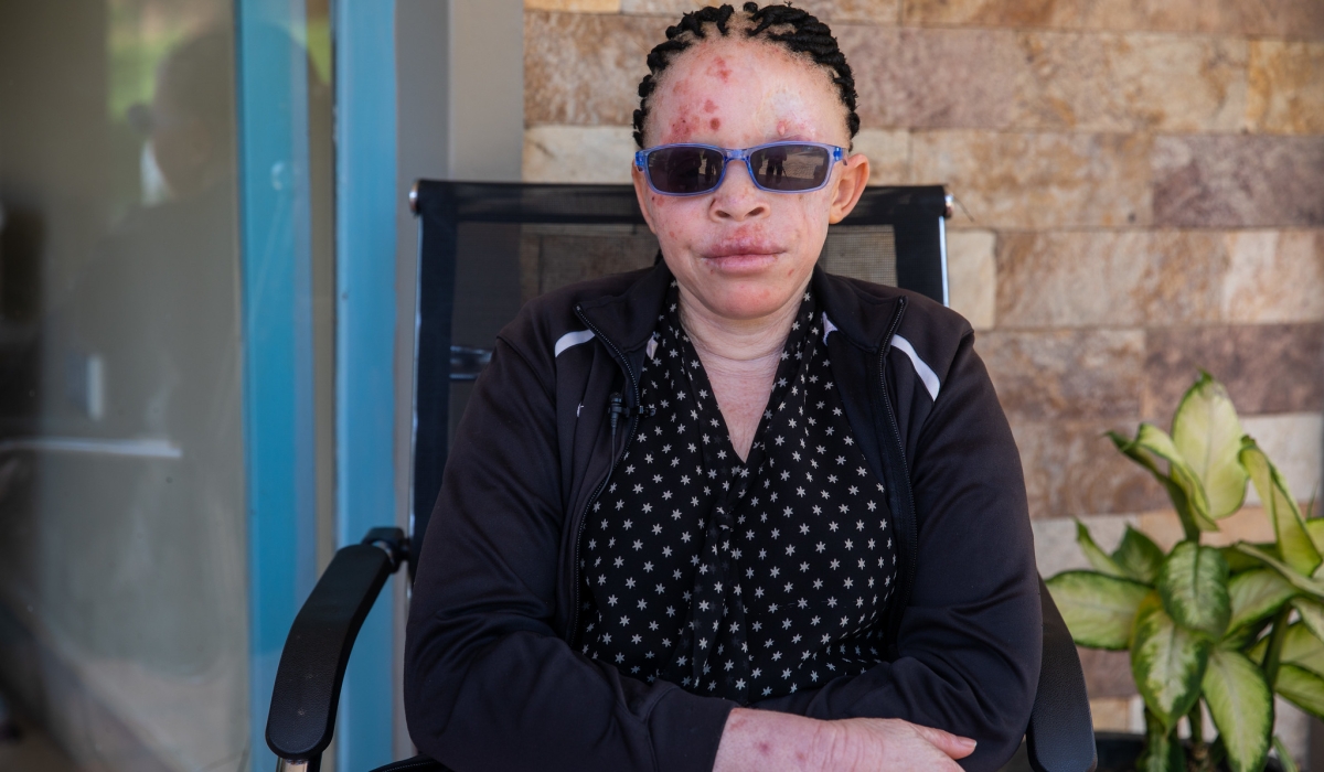 Annet Manishimwe born with albinism, later diagnosed with skin cancer. Willy Mucyo