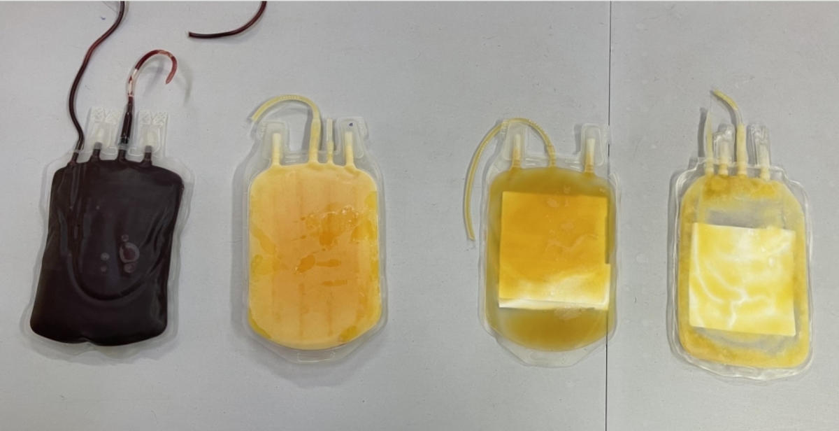 RBC explores new use for extra plasma from blood donations RBC explores new use for extra plasma from blood donations