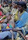 A child suffering from Kwashiorkor. (Photo / WFP).
