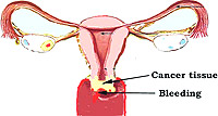 Illustrations of the cervical cancer within the Uterus area.