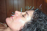 Needles pieced in a womanu2019s face to ease pain (Net photo)