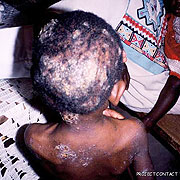 Scabies are most spread amongst children while playing outside.