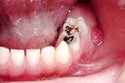 A tooth abscess is extremely painful