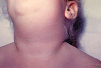 MMR vaccination counters mumps.