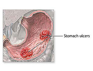 Stomach Ulcers (Internet Photo)