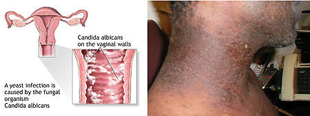 L-R : Yeast-Infections ; An infection on the right side of the neck