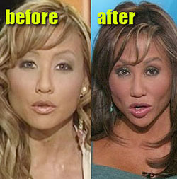 Mia Lee  a famous Los Angeles TV personality before and after lip implants(Photo Internet)