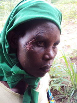 Immaculee Mukashyaka shows the scar she sustained after a scuffle with a local leader (Photo by Bucyensenge).