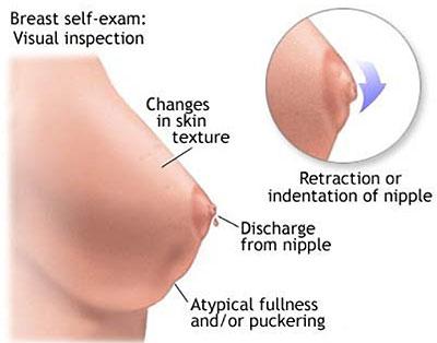 Monthly breast self-exams should always include visual inspection to identify unusual changes. Net Photo. 