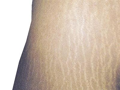 Stretchmarks create a lot of discomfort among women.  The New Times / File
