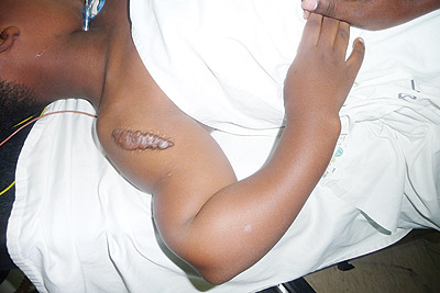 An example of Enchondroma.