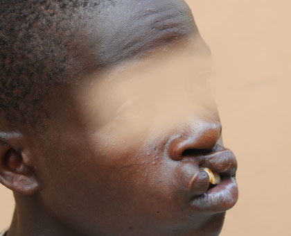 A patient with cleft lips. At least 300 children are born with the deformity in the country annually, officials say. Saturday Times/ Timothy Kisambira. 