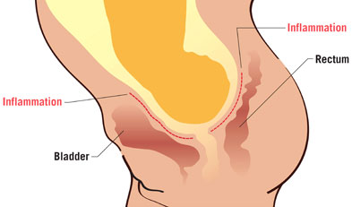 During prolonged labour, the compression of soft tissues (as indicated by the red lines) between the baby's head and the woman's pelvis cuts off blood flow to the bladder or rectum. As a result, tissue dies, leaving a hole, or fistula. Net photo