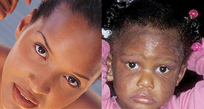 We all love beautiful skin (L) but eczema can mess it all up and turn our life into misery. Net photos.