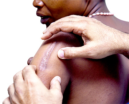 A woman with a scar on her shoulder is screened for the corrective surgery at CHUK yesterday.  The New Times/  T. Kisambira.