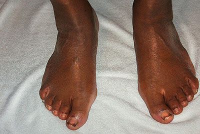 Why are my toe nails turning black? - The New Times