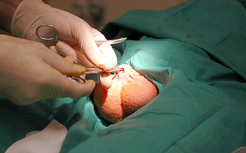 A man undergoing a vasectomy operation. (Internet photo)