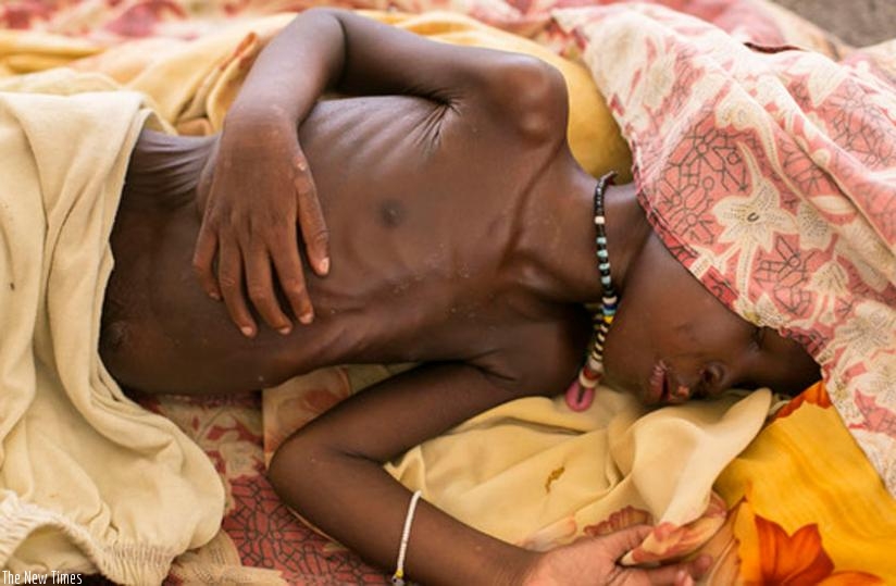 A malnourished child lies on the bed at MSF hospital Bentiu, South Sudan. (AP)