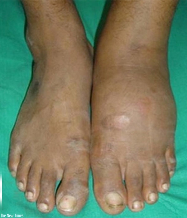 A man with swollen feet. Elderly people can have swelling of the feet due to stiffness of joints. (Net photo)
