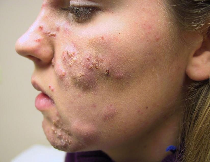 A woman with acne on the face. (Net photo)