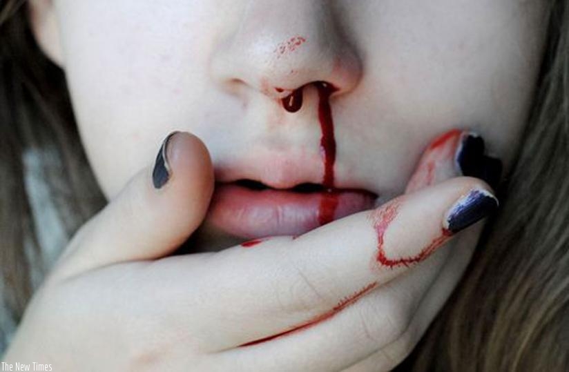 A girl experiencing nose bleeding. (Net photo)