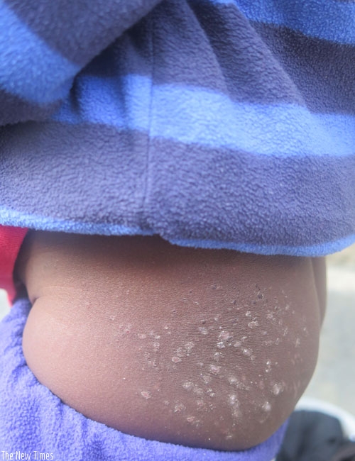 A child with atopic eczema (affected area circled). (Lydia Atieno)