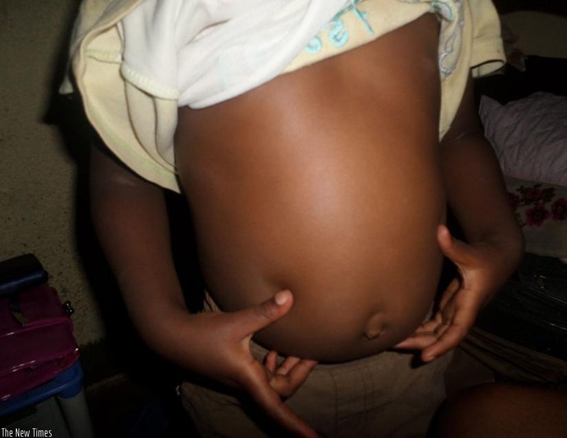 Swelling of the stomach in children is linked to presence of worms in their bodies. (Solomon Asaba)