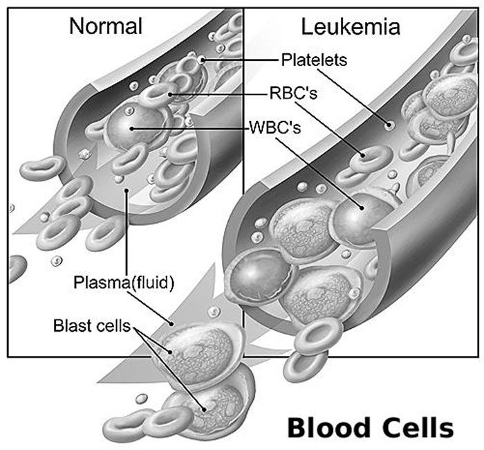 A graphic illustration of how leukemia affects the blood cells. (Net photo)
