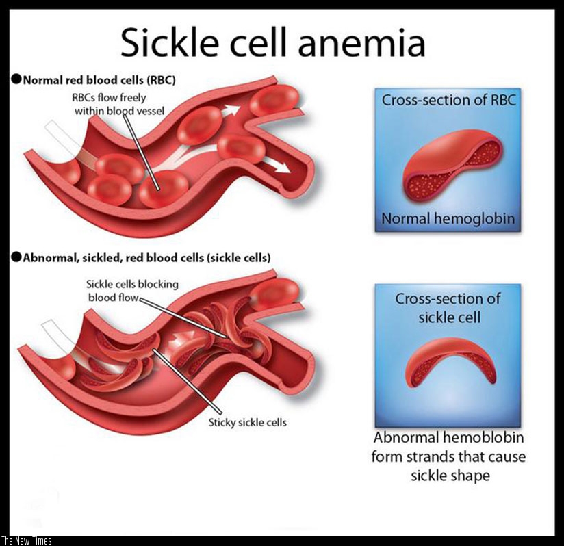 A graphic illustration of how sickle cells affect normal blood circulation. Internet photo.