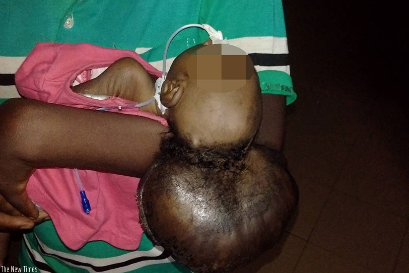 Mukankuranga and baby Ester Niyigena at CHUK before the operation. / Photo by Kelly Rwamapera.