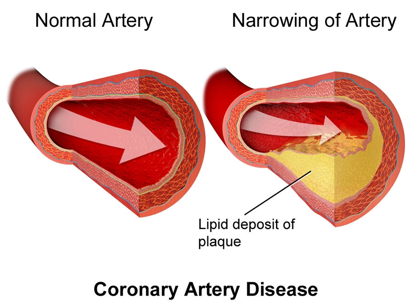 A graphic illustration of how coronary heart diseases affects the heart. (Net photo)