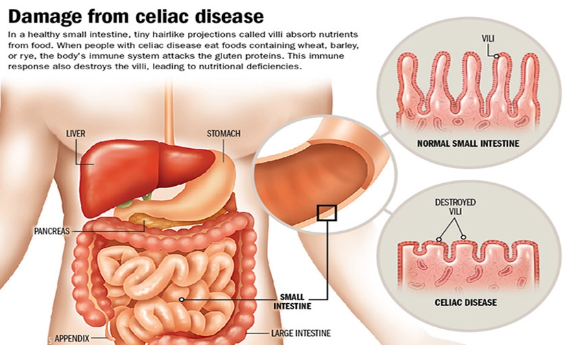 A graphic illustration of how celiac disease affects the intestinal lining. / Net photo.