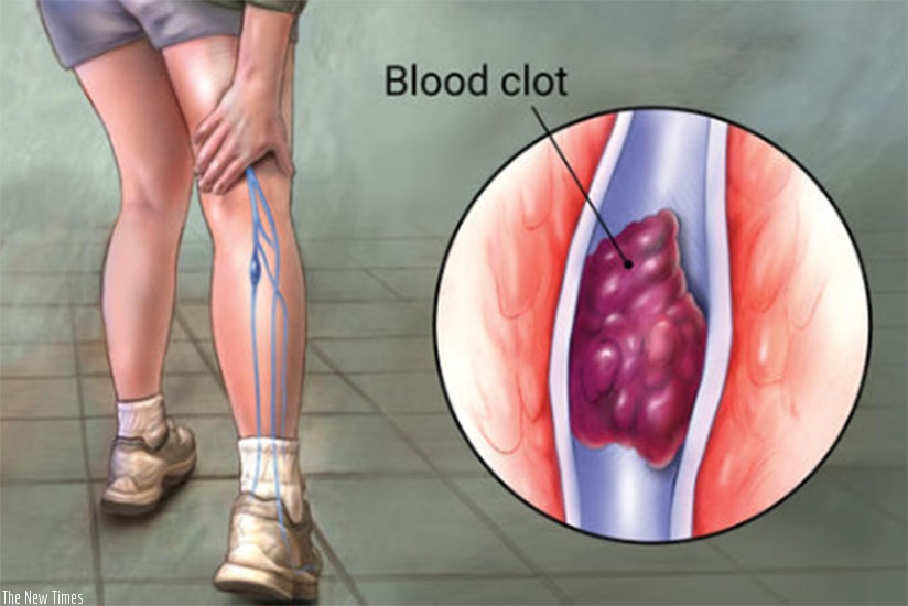 A graphic illustration of deep vein thrombosis. / Net photo.