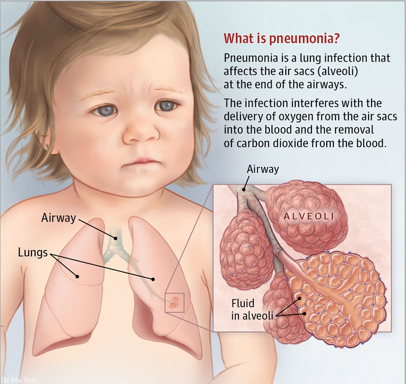 A graphic illustration of how pneumonia affects a child. / Net