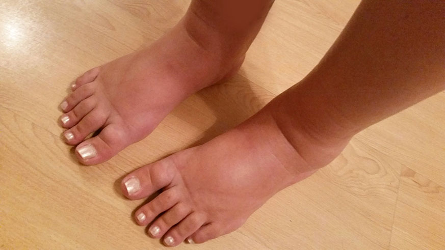 Swollen feet of a pregnant woman