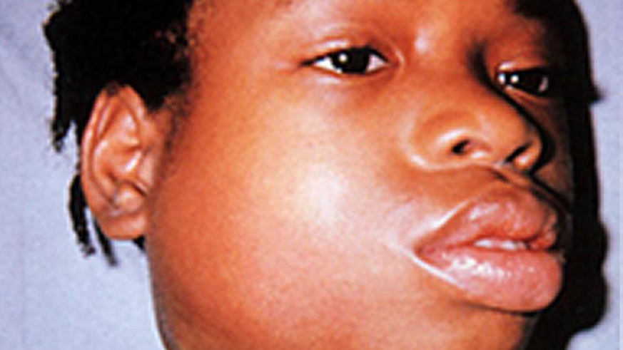 A child suffering from mumps / Net photo.