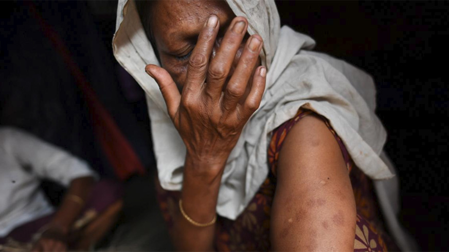 A Rohingya refugee woman shows bullet and shrapnel wounds on her arm at Shamlapur refugee camp in Cox's Bazaar, Bangladesh, March 26, 2018. The wounds are from when she was hit by the Myanmar army as she tried to escape in September 2017. / Internet photo