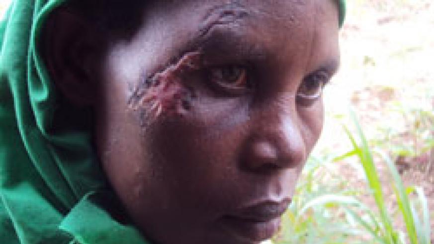 Immaculu00e9e Mukashyaka shows the scar she sustained after a scuffle with a local leader in Gisagara district. (Photo by Bucyensenge).