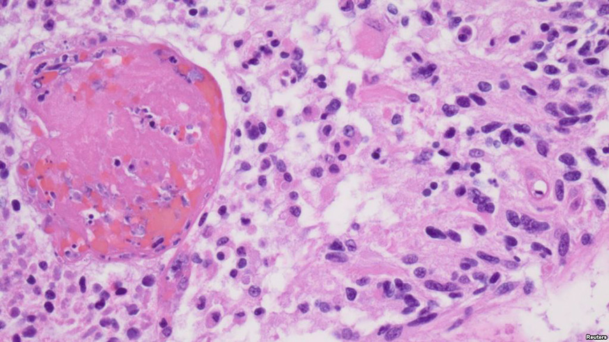 A high-magnification image from a 2012 glioblastoma case is seen as an example in this College of American Pathologists image released from Northfield. Net photo.