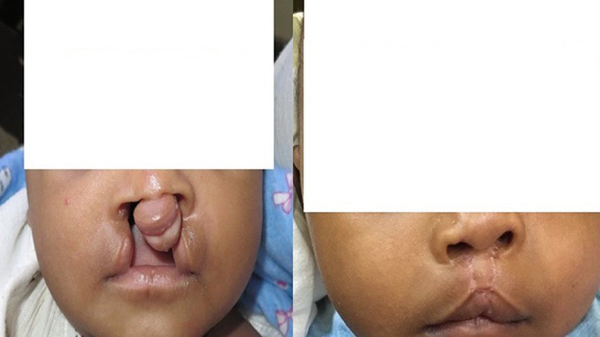 A baby before and after orofacial cleft surgery repair at Rwanda Military Hospital /Courtesy Photo