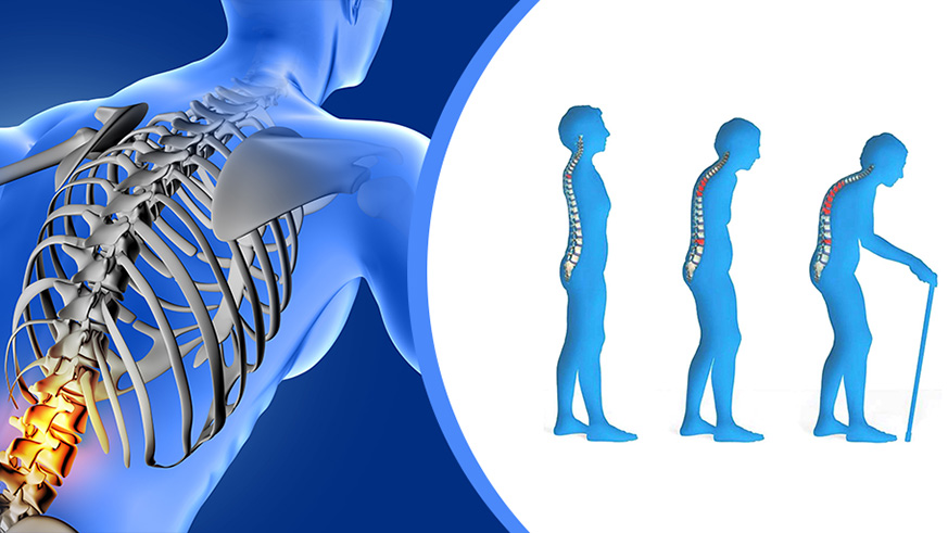 Osteoporosis results in bones becoming more fragile and therefore breaking more easily. /Courtesy Photo